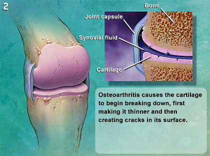 Knee surgery shows no benefit for people with mild osteoarthritis